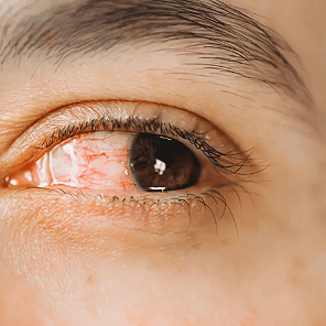 UVEA Y GLAUCOMA CARD (1)
